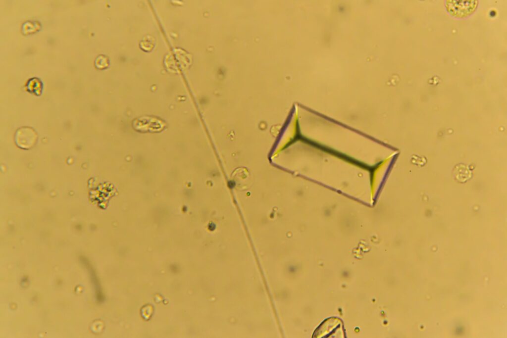 Struvite crystals under a microscope