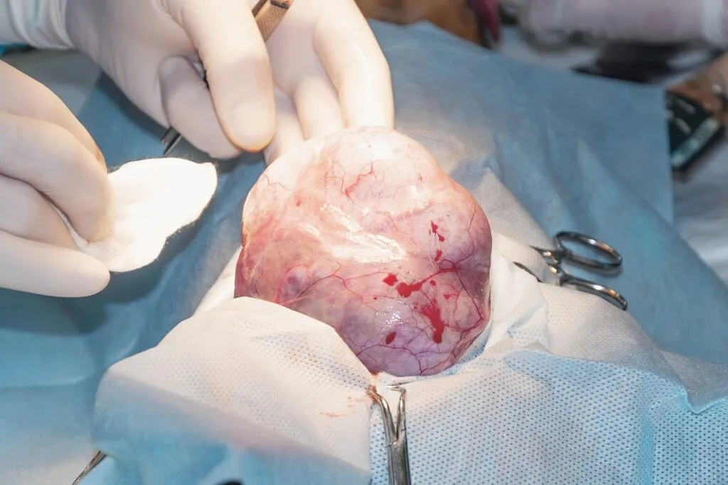 Tumour removal surgery in process.
