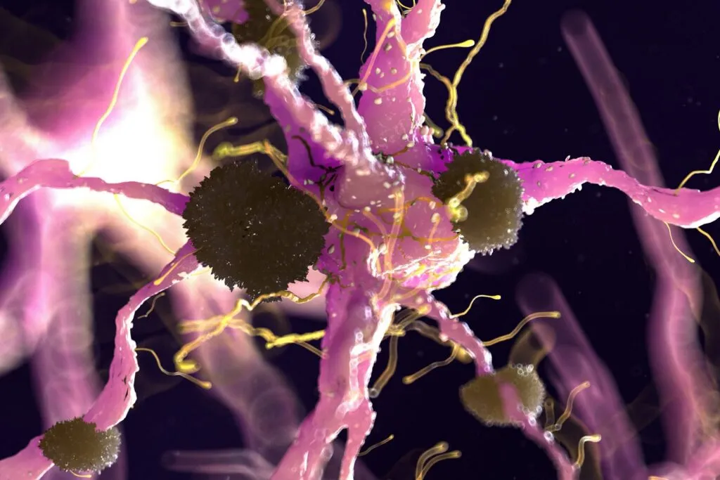 Illustration of amyloid protein damaging nerve cells in Alzheimer’s disease